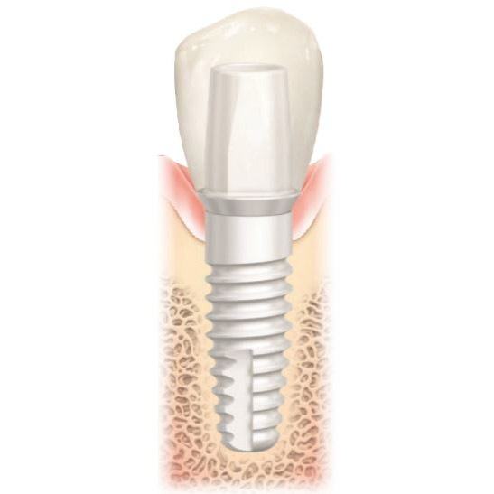 Ceramic Dental Implants Metal Free Farber Center Long Island