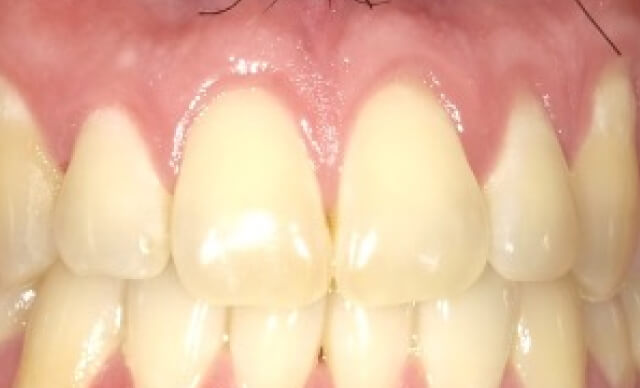 Pinhole® Gum Rejuvenation before