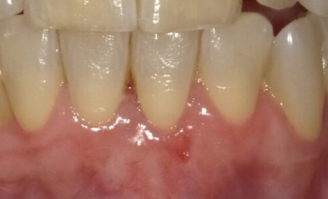 Soft Tissue Graft after