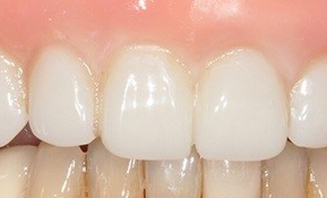 Dental Implant Restoration after