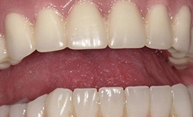 Full Smile Reconstruction after