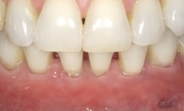 Pinhole® Gum Rejuvenation after