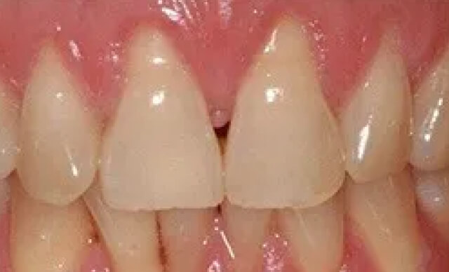 Pinhole® Gum Rejuvenation before