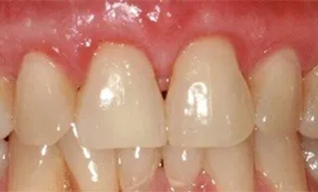 Pinhole® Gum Rejuvenation after