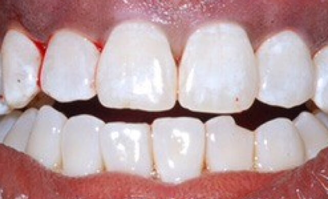 Pinhole® Gum Rejuvenation after