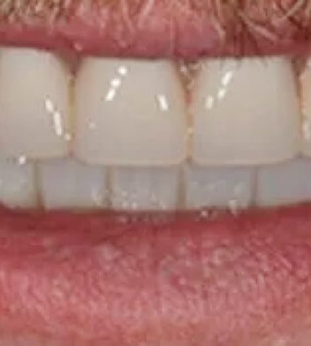 Patient after full-arch dental implants