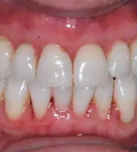Patient after pinhole gum recession treatment