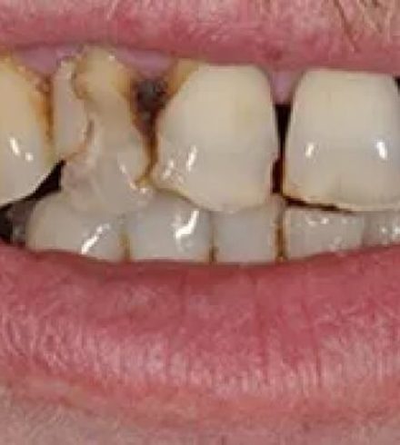 Patient before full-arch dental implants