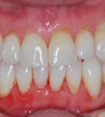 Patient before pinhole gum recession treatment