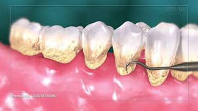 Periodontal Disease: A Treatable Condition