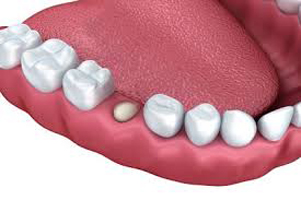 Increased Tooth Loss Risk for Senior Citizens