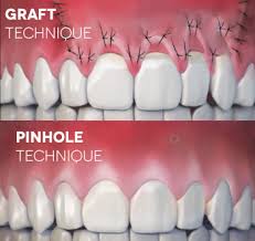 Pinhole Gum Surgery: Look Better with Less Discomfort