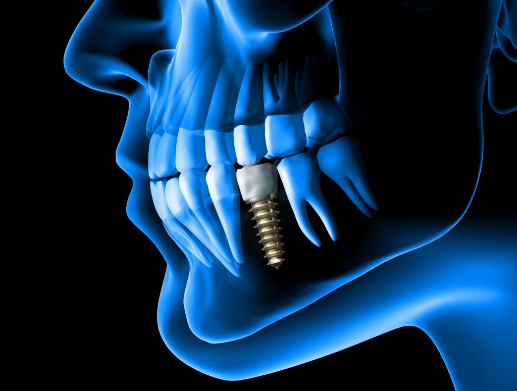 Dental Implant Strength: How Strong Are They?