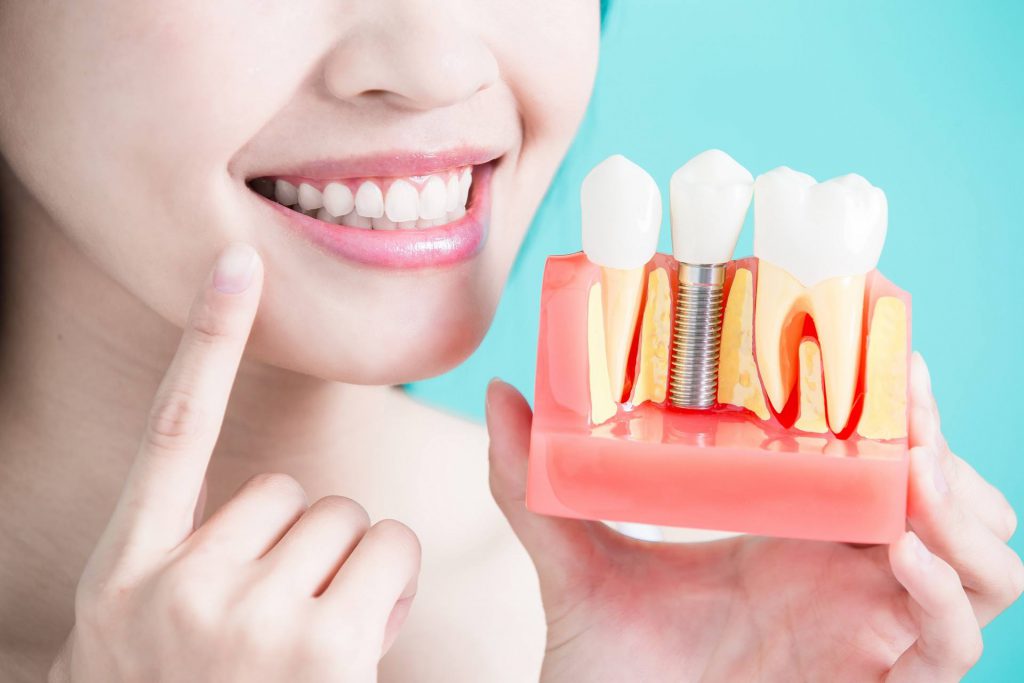 Keep Your Dental Implants Healthy and Beautiful