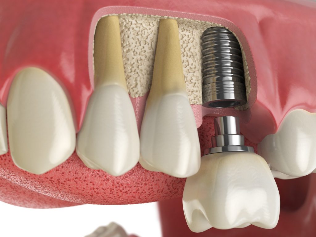 Sinus Lift Surgery Makes Dental Implants Possible