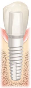 ceramic dental implant