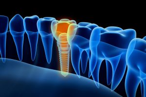 dental implant