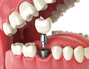 3d model showing an exploded view of a dental implant