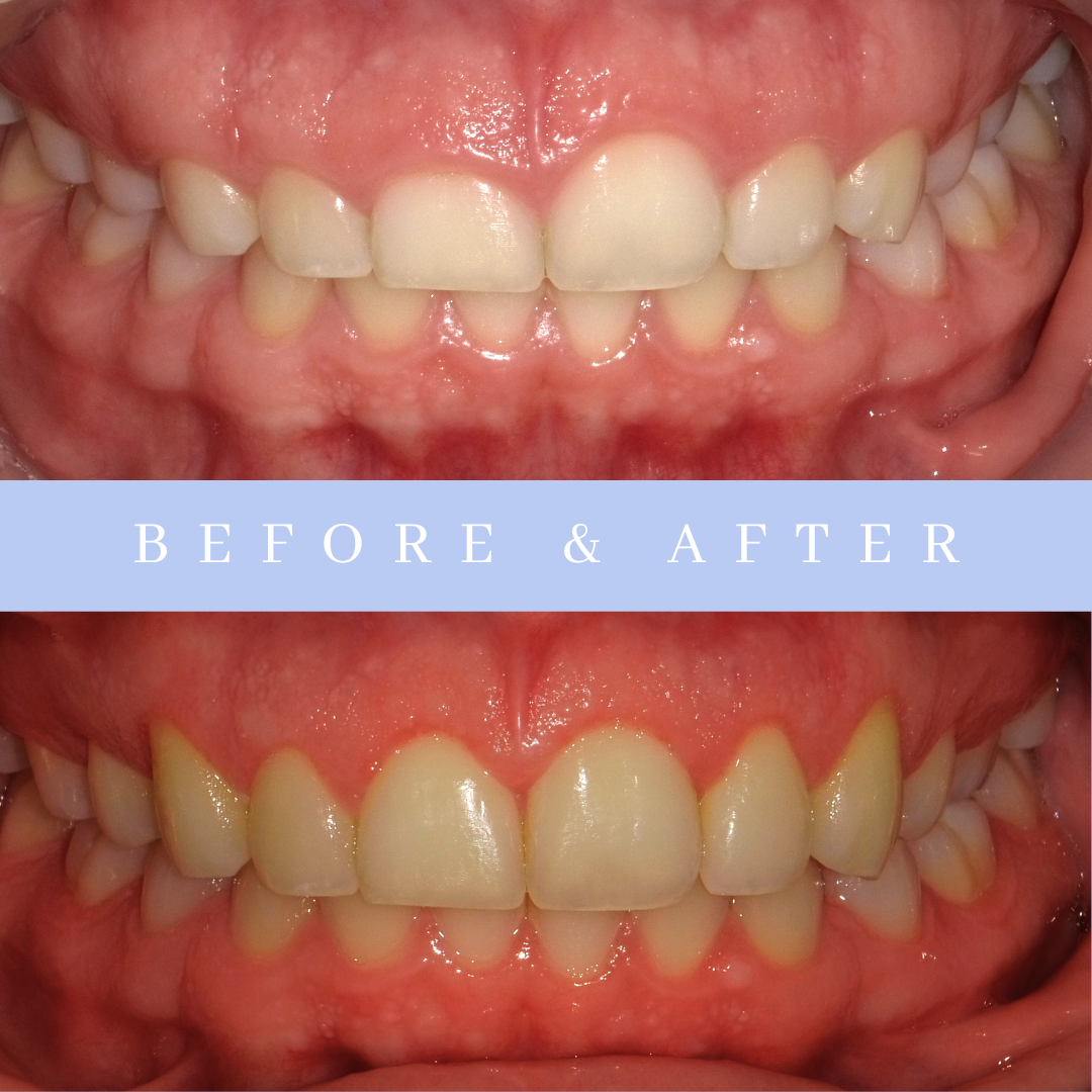 Gummy Smile Treatment Long Island | Crown Lengthening | Gummy Smile Surgery